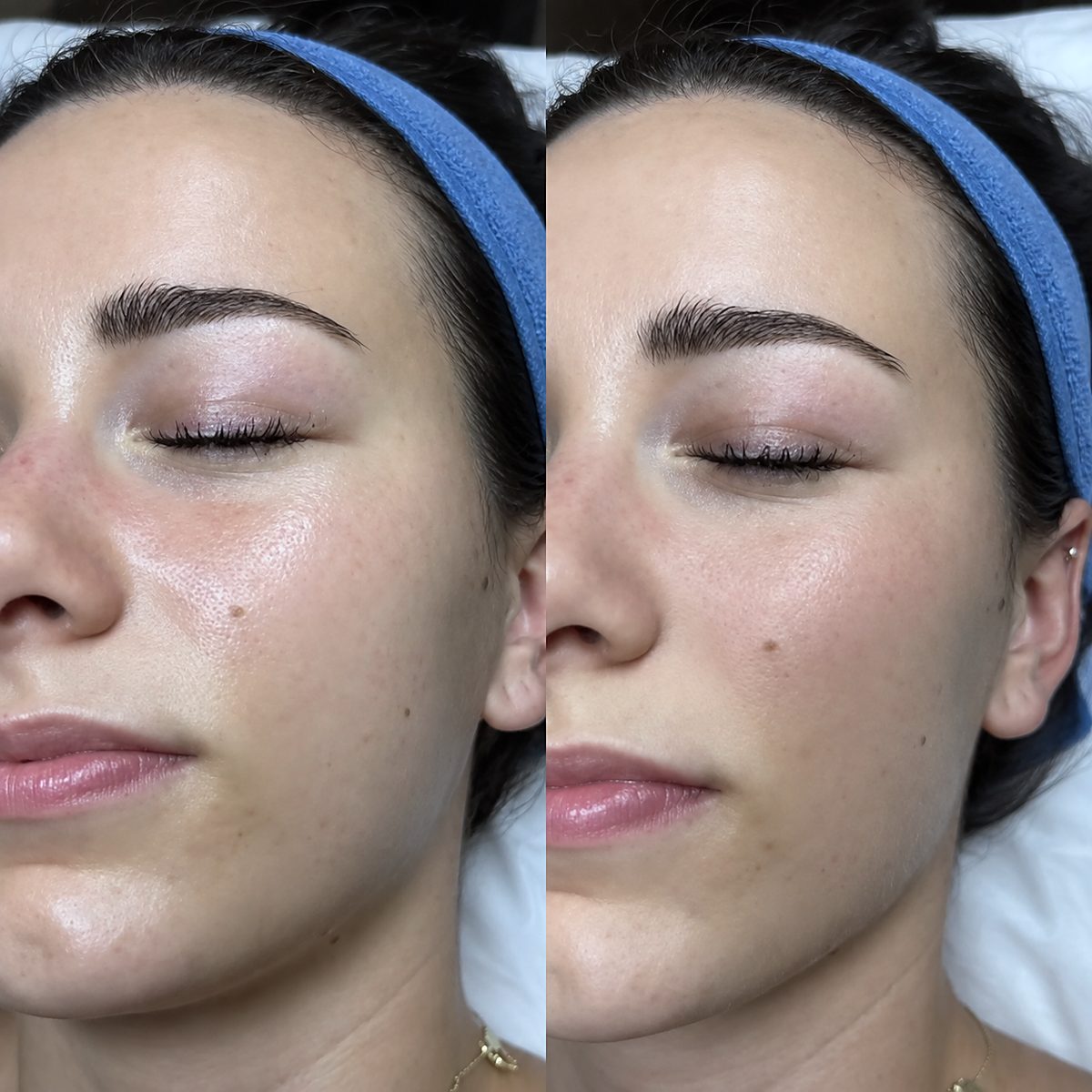 Curs online de dermaplaning